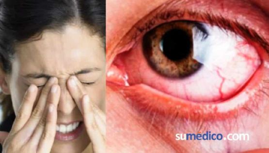 Glaucoma: la enfermedad silenciosa que provoca ceguera irreversible