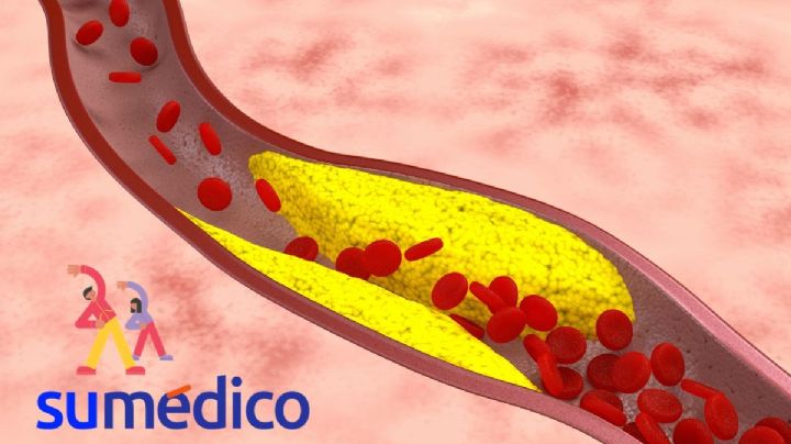 Menor riesgo de padecer ateroesclerosis si realizas este ejercicio