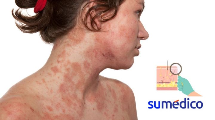 Dermatólogos darán consultas gratuitas para dermatitis atópica ¿Dónde y cuándo?