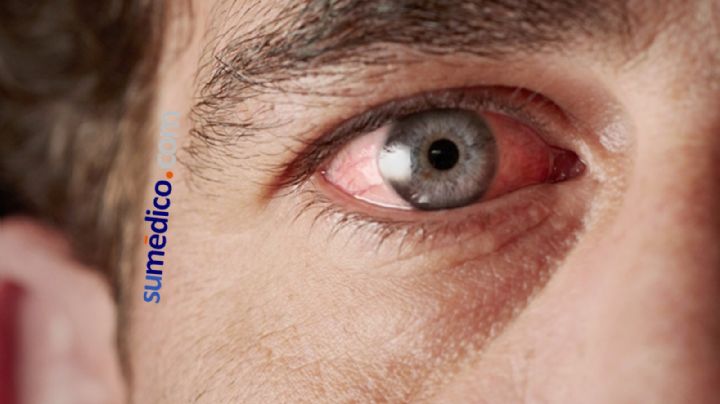 Estas son las causas de que tus ojos se pongan rojos