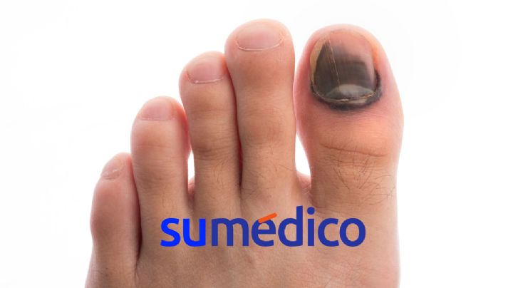 ¿Qué significan los diferentes colores en las uñas de los pies?