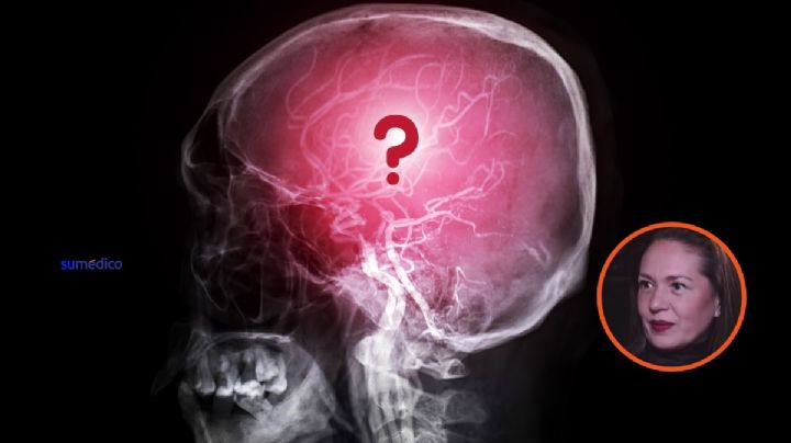 ¿Qué es la hemorragia cerebral, posible afección por la que Yolanda Andrade fue hospitalizada?