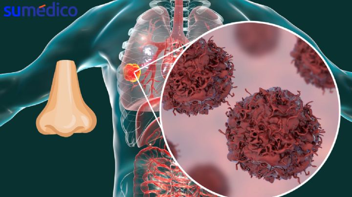 Crean nariz electrónica capaz de detectar casos tempranos de cáncer de pulmón