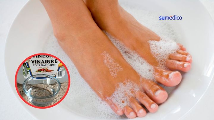 ¿Cómo eliminar hongos de los pies con vinagre?