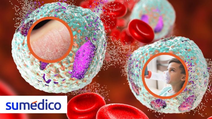 Dupilumab, alternativa de tratamiento ante enfermedades inmunológicas