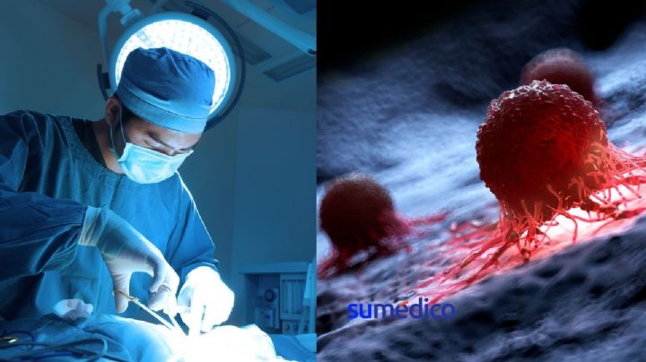 El 80% de personas con cáncer requerirán cirugía: expertos
