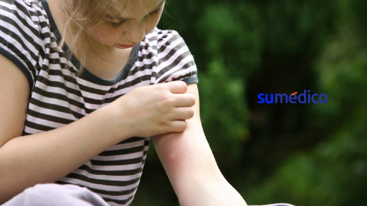 Alergia a los mosquitos: por qué ocurren y cómo prevenirlas