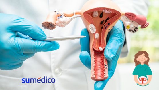 Nuevo tratamiento contra cáncer cervicouterino reduce riesgo de muerte en un 40%