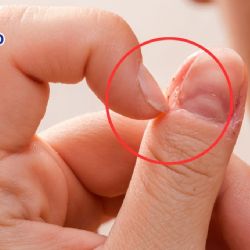 ¿Por qué salen padrastros en las uñas y qué hacer si se infectan?