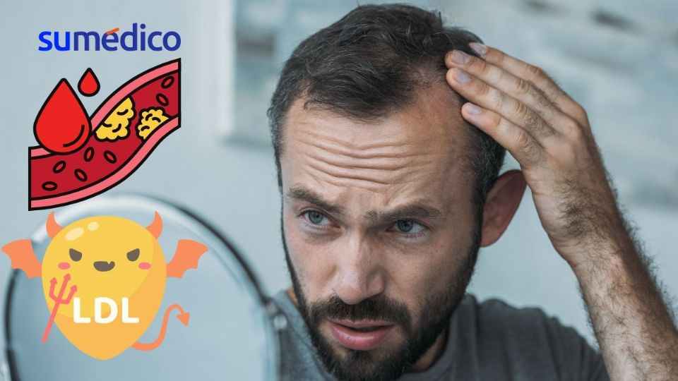 ¿El colesterol alto puede causar alopecia?