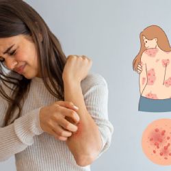 ¿Qué es la psoriasis y cómo afecta a la vida diaria de las personas?