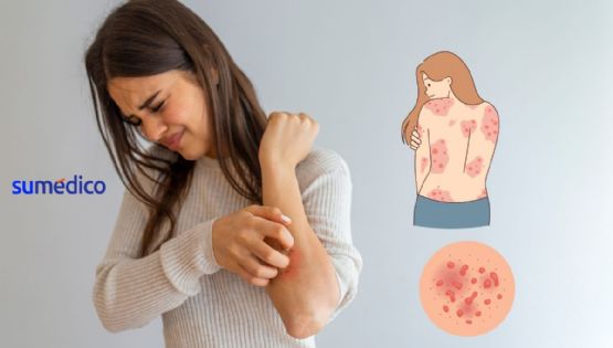 ¿Qué es la psoriasis y cómo afecta a la vida diaria de las personas?