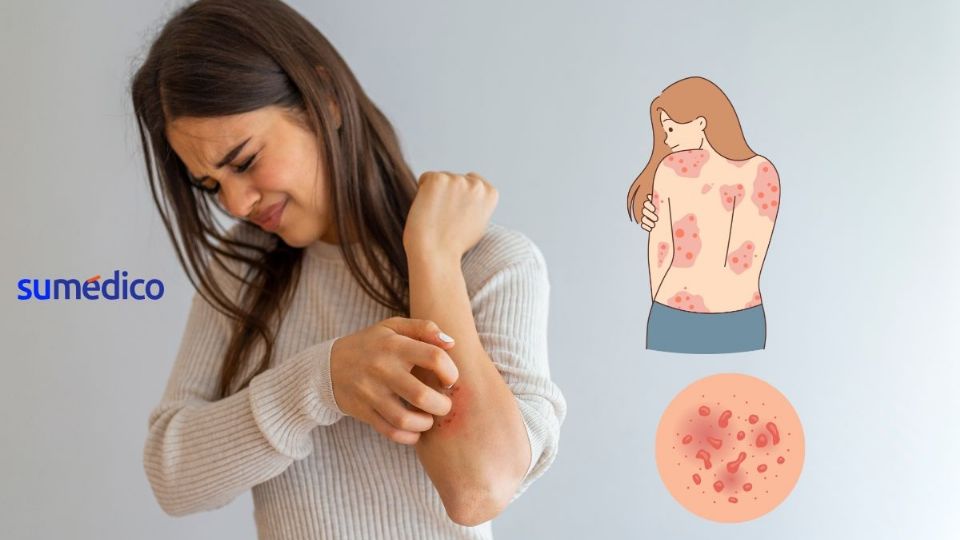 La psoriasis puede ser muy nolesta