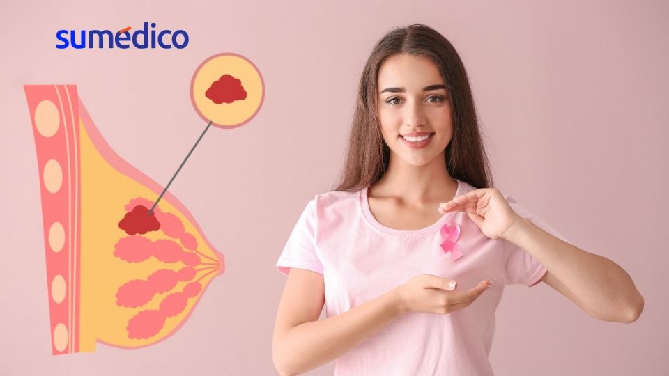 Cada vez hay más casos de cáncer de mama en mujeres jóvenes