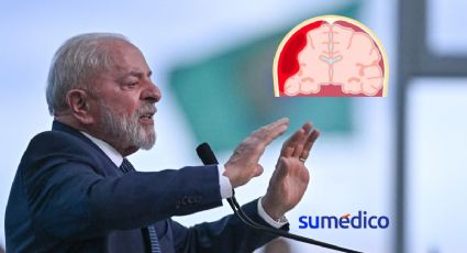 ¿Qué es la hemorragia intracraneal que sufrió Lula Da Silva?