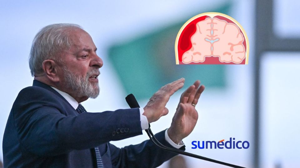 La hemorragia intracraneal provocó que Lula Da Silva haya sido hospitalizado