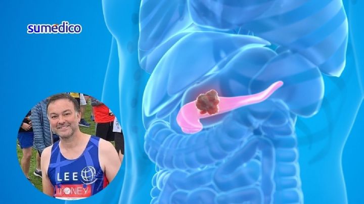 'Corría maratones, mis estudios eran perfectos y desarrollé cáncer de páncreas'