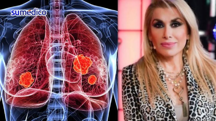 ¿Qué causa el cáncer de pulmón que habría tenido la cantante Dulce?