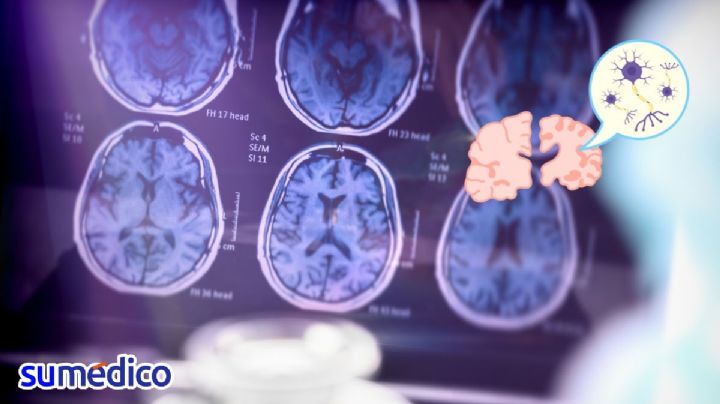 ¿Cómo funciona el nuevo medicamento para Alzheimer aprobado por Cofepris?