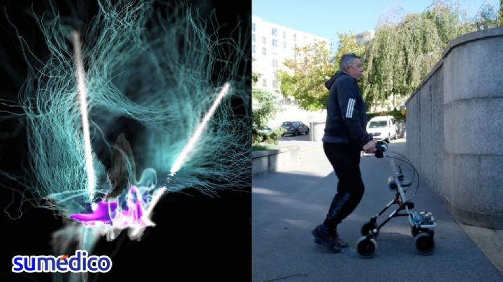 El implante cerebral por el que dos personas volvieron a caminar