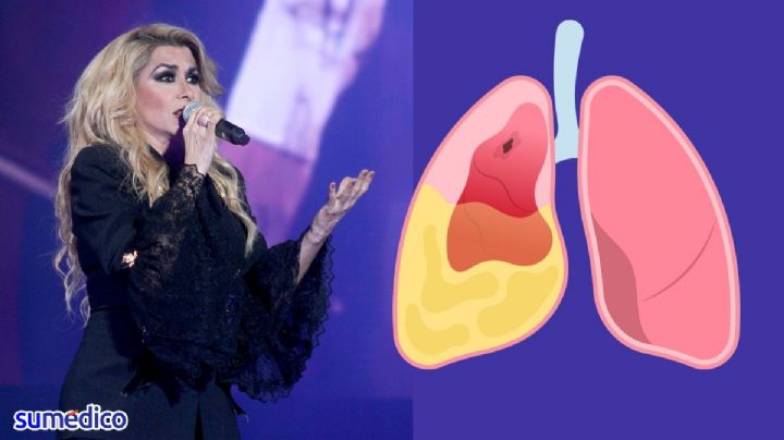 ¿Qué es el empiema pleural? La enfermedad que tiene la cantante Dulce
