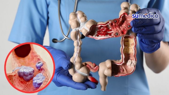 Cáncer de recto, cada vez más frecuente en menores de 50 ¿Cómo prevenir?