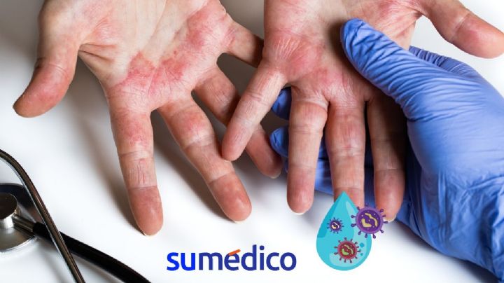 Recomendaciones de una dermatóloga para cuidar tu piel del agua contaminada en CDMX