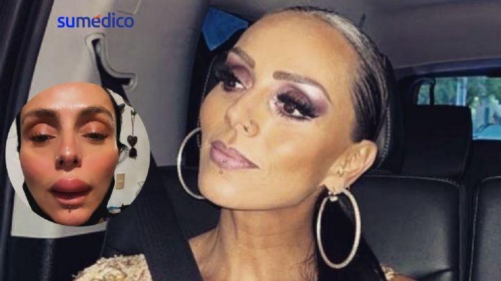 ¿Qué causa la hinchazón repentina de labios como la que sufrió Ivonne Montero?