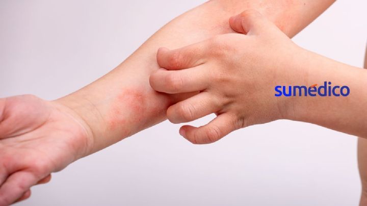 ¿Cómo afecta la dermatitis atópica a los niños?