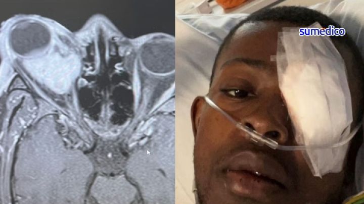 Joven de 24 años tenía un ojo más saltón que otro; era por un raro cáncer