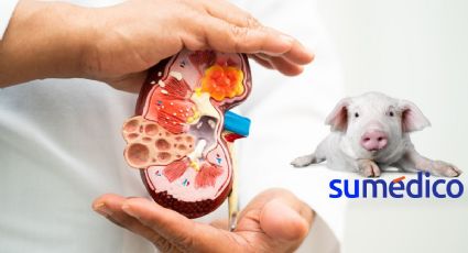 Paciente recibe el primer trasplante de riñón de un cerdo ¿Cuál es su estado de salud?
