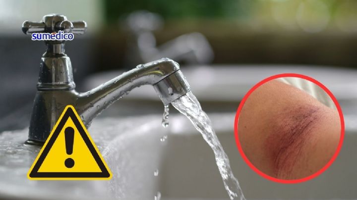 ¿Qué es el eccema que podría estar causando el agua de algunas colonias en CDMX?