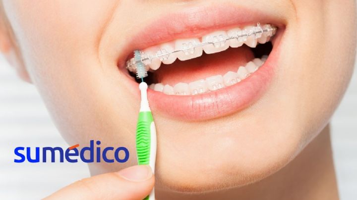 ¿Cómo cepillar mis dientes si tengo brackets?