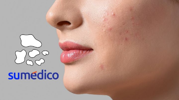 ¿Qué significa tener manchas blancas en la piel? Conoce sus causas y tratamiento
