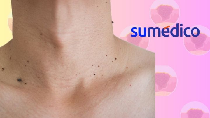 ¿Cómo eliminar las verrugas en el cuello?