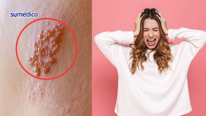 Síntomas de herpes zóster, la enfermedad por estrés