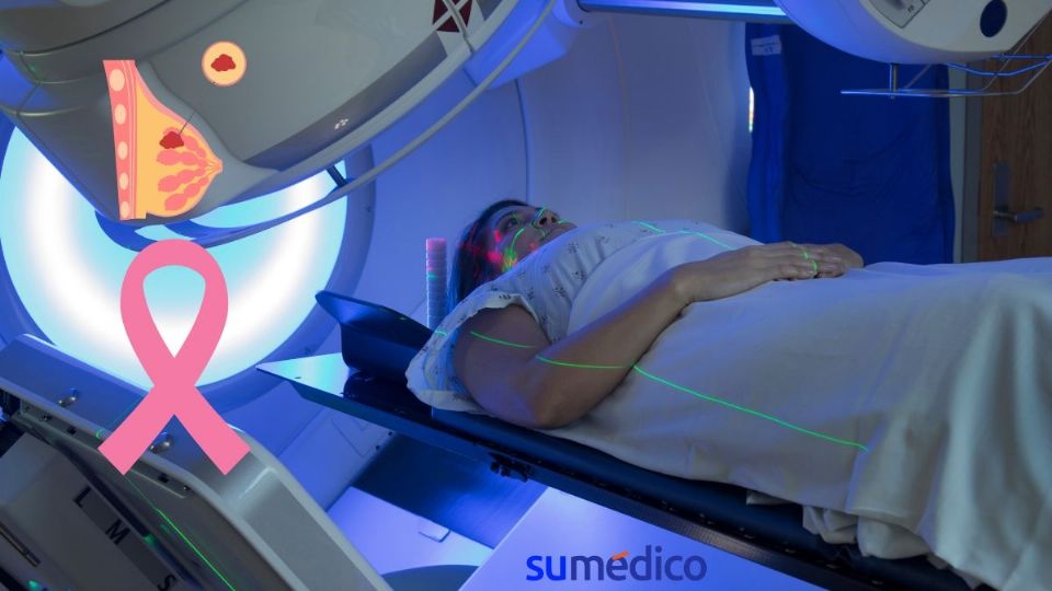 La radioterapia puede curar el cáncer de mama