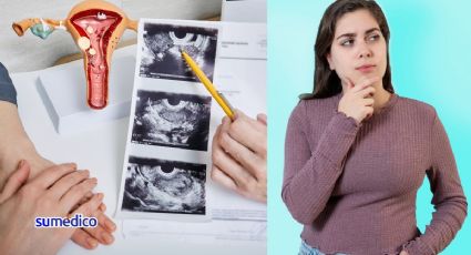 Síndrome de Ovario Poliquístico o SOP: ¿Qué es?