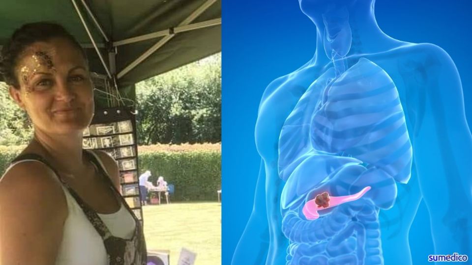 El cáncer de páncreas no suele presentar síntomas sino hasta que ya se diseminó a otros órganos