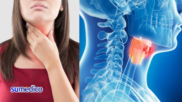 ¿Qué síntomas da el cáncer de garganta? 5 señales que NO debes ignorar