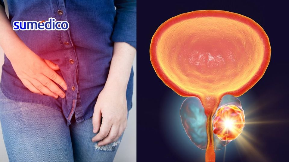 El cáncer de vejiga es más común en los hombres que en las mujeres.