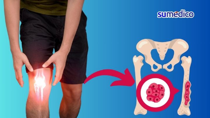 ¿Qué síntomas da el cáncer de hueso? 5 señales que NO debes ignorar