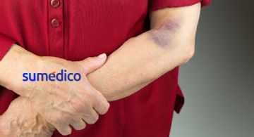 ¿Qué significa que los adultos mayores tengan moretones de la nada?