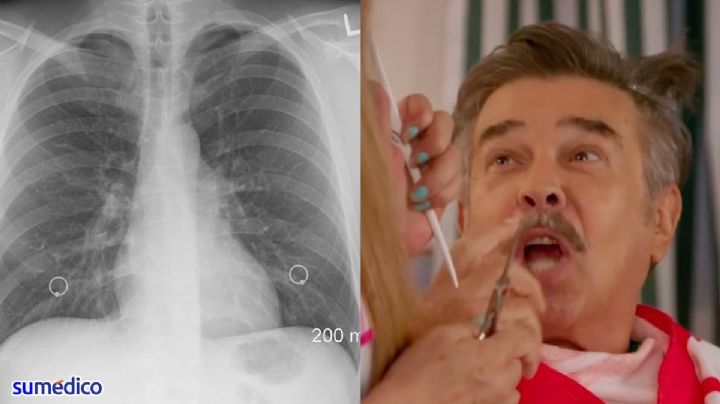 ¿Cuál fue el primer síntoma de cáncer de pulmón que tuvo Jorge Ortiz de Pinedo?