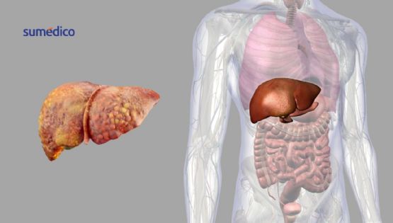 Identifican proteína clave en la progresión del hígado graso