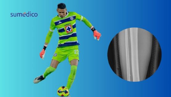 Kevin Mier: ¿qué tan grave es la fractura de tibia que sufrió el arquero de Cruz Azul?