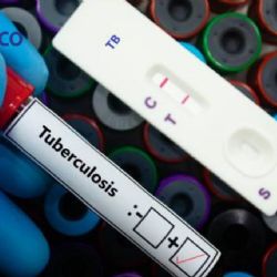 Donald Trump corta fondos y la tuberculosis vuelve a amenazar al mundo