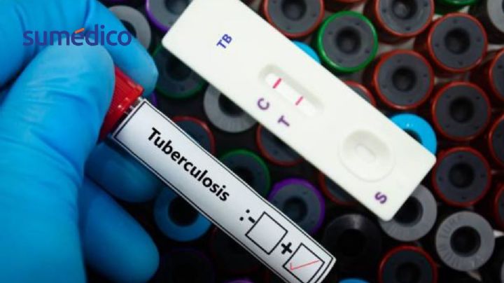 Donald Trump corta fondos y la tuberculosis vuelve a amenazar al mundo