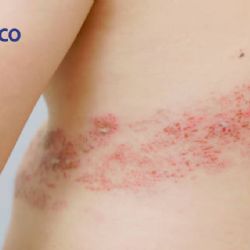 ¿Qué personas son más propensas a tener herpes zóster?