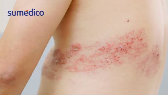 ¿Qué personas son más propensas a tener herpes zóster?